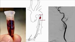 Thrombectomy in acute stroke – can we extend the time window [upl. by Otrebliw596]