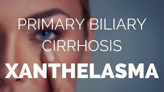 Primary biliary cirrhosis xanthelasma explained [upl. by Notserk]