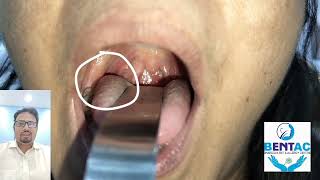 information about tonsillolith and tonsil stone removal in hindi [upl. by Hamer]