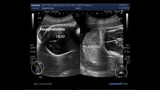 Ultrasound Video showing intrauterine fetal death with positive spalding sign and an encephalocele [upl. by Nref578]