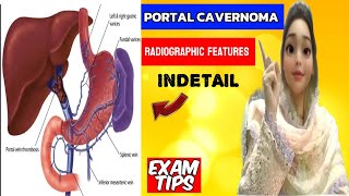 Cavernous Transformation of Portal Vein  Portal Vein thrombosis  Portal Vein Cavernoma [upl. by Algar]