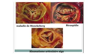 rétrécissement aortique [upl. by Petulia589]