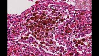 Histopathology Lung Chronic pulmonary congestion [upl. by Annohsal187]