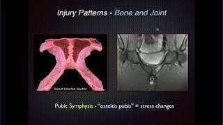 Imaging of Groin Pain Athletic Pubalgia [upl. by Nadnarb]