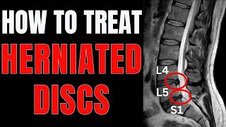 Herniated Disc at L4L5 or L5S1 Simple Tips to Relieve Back Pain [upl. by Arabella]