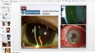 Acute iridocyclitis [upl. by Lizzie]