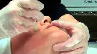 Dermapen Micro Needling Treatment [upl. by Magnum]