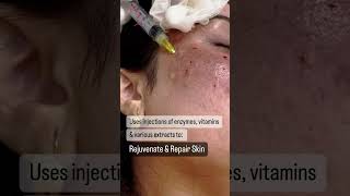 Mesotherapy for Skin Repair [upl. by Almat9]