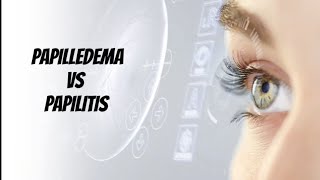 Papilledema VS Papillitis Optic neuritis [upl. by Balcer]