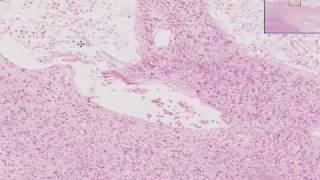 Histopathology Brain Cerebral infarct recent [upl. by Rosenkranz]