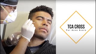 TCA Cross for Acne Scars Darker Skin Tone Ice Pick Scars [upl. by Ecerahs]