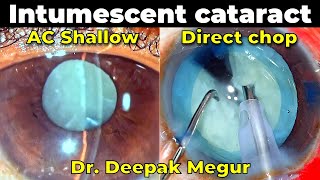 Intumescent cataract and Two stage rhexis  AC Shallow Phacoemulsification  Dr Deepak Megur [upl. by Batha]