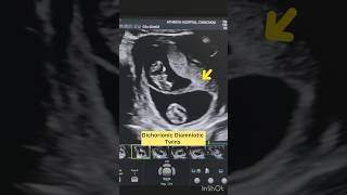 “Key Ultrasound Findings in Dichorionic Diamniotic Twins” [upl. by Iaht]