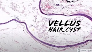 Vellus Hair Cyst 5Minute Pathology Pearls [upl. by Suiddaht]