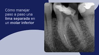 Cómo manejar paso a paso una lima separada en un molar inferior [upl. by Watson353]