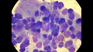 Neuroblastoma in the bone marrow [upl. by Mittel278]