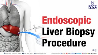 Endoscopic Liver Biopsy Procedure  shortvideo liverbiopsy [upl. by Naahsar722]