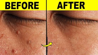 9 Effective Ways To Remove Skin Tags At Home [upl. by Yeltihw]