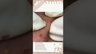 Big Cystic Acne Blackheads Extraction Blackheads amp Milia Whiteheads Removal Pimple Popping shorts [upl. by Dov]