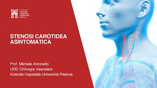 Stenosi Carotidea Asintomatica  Prof Michele Antonello [upl. by Corson]