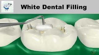 Composite Dental Filling Procedure [upl. by Tarrant816]