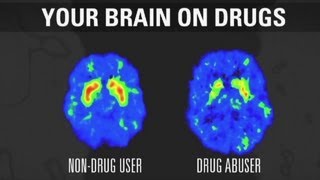 How addiction changes your brain [upl. by Ailahk500]