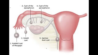 Gynecology 057 Wolffian duct remnant abnormality Gartner duct cyst Hydatid Morgagni Epoophoron [upl. by Pauline897]