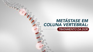 Metástases na coluna vertebral [upl. by Veriee]