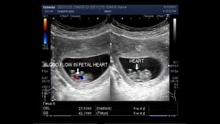 Pregnancy of about 09 weeks on Ultrasound [upl. by Amar]