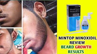 Mintop minoxidil 5 beard  dr reddy minoxidil 5 results  dr reddy minoxidil 5 beard growth results [upl. by Tram446]