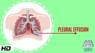 Pleural Effusion Causes Signs and Symptoms Diagnosis and Treatment [upl. by Anaizit93]