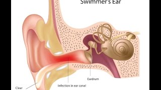 Otitis Externa [upl. by Beedon]