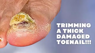 Trimming a THICK DAMAGED Toenail [upl. by Ecirpac]