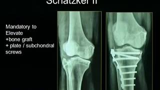 Tibial Plateau Fractures [upl. by Alik780]