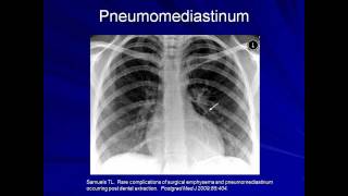 Lung Protective Ventilation Mechanical Ventilation  Lecture 9 [upl. by Eilrebma]