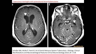 31 Neurosarcoidosis and tuberculous meningitis leptomeningeal perivascular granulomatous [upl. by Itsrik]