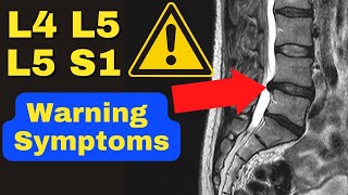 WARNING These Are The 3 MAJOR Symptoms of a Severe L4 L5 L5 S1 Disc Bulge  Dr Walter Salubro [upl. by Alya]