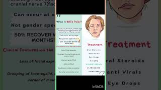 Bells Palsy Facial Paralysis shortvideoshortfeed [upl. by Kcirdehs]