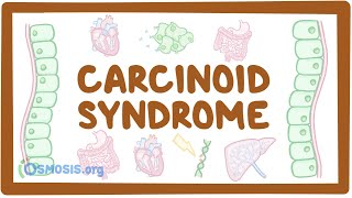 Carcinoid Syndrome  causes symptoms diagnosis treatment pathology [upl. by Darb]