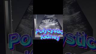 Polycystic Kidneys  Renal Cysts  Kidney Cysts on ultrasound [upl. by Akirdnas]