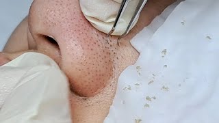 Satisfying Relaxing Skin Deep Clean  Halo Skin Hong Kong Acne and Blackheads 黑頭粉刺 Shorts [upl. by Dorry]