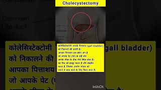 Whats the Cholecystectomy procedure gallbladderstone gallstones gallstonetreatment healthfacts [upl. by Darton]