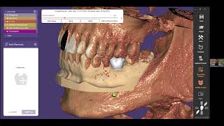 Implant Planning amp Surgical Guide Designs on Exoplan  EVIDENT LabToLab Education Series Ep 87 [upl. by Lavern]