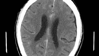 CNS C6 Leptomeningeal enhancement [upl. by Peirce977]