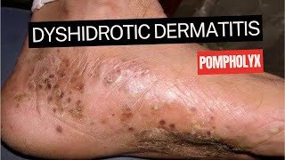 Dyshidrotic Eczema Pompholyx [upl. by Ttenyl]