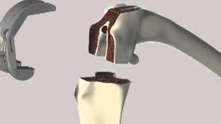 Total Knee Replacement Animation [upl. by Enilekcaj]