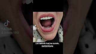 PROTEZA ANTIALERGJIKEgoviral fypage dentist smile dentalclinic cosmeticdentistry goviral [upl. by Allenad926]