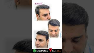 Incredible 4500 Grafts Hair Transplant Results 3 Year Review [upl. by Ydnahs755]