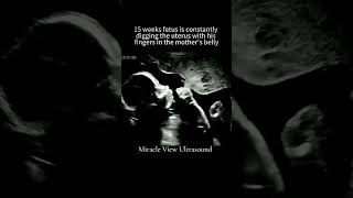 Ultrasound scan In Pregnancy [upl. by Wey]