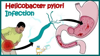 Achlorhydria  Hypochlorhydria  Causes  Symptoms  Risk Factors  Diagnose  Treatment [upl. by Rizika]